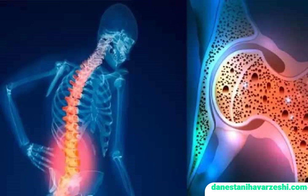 پوکی استخوان چیست + ورزش مناسب پوکی استخوان - دانستنی های ورزشی پوکی استخوان چیست + ورزش مناسب پوکی استخوان