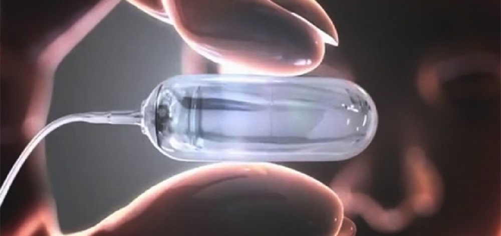 با تکنولوژی قرص بالن خیلی راحت لاغر شوید!