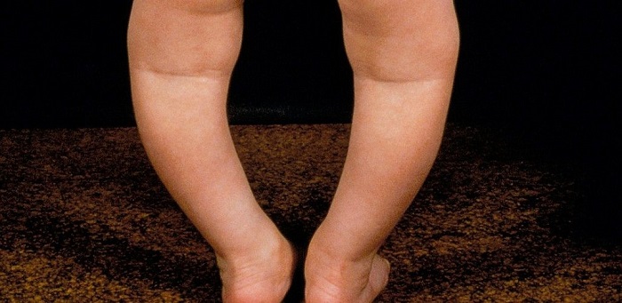 پا پرانتزی در کودکان