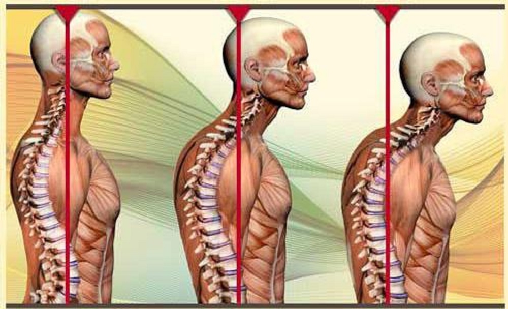 ناهنجاری سر به جلو و حرکات اصلاحی درمان سر به جلو - دانستنی های ورزشی ناهنجاری سر به جلو و حرکات اصلاحی درمان سر به جلو