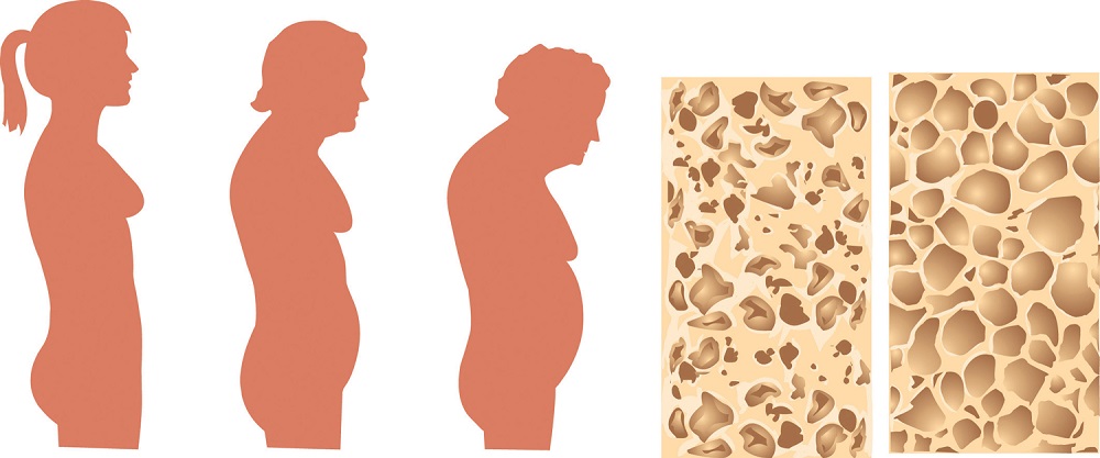 چاقی و پوکی استخوان؛ چرا چاقی باعث پوکی استخوان می‌شود؟