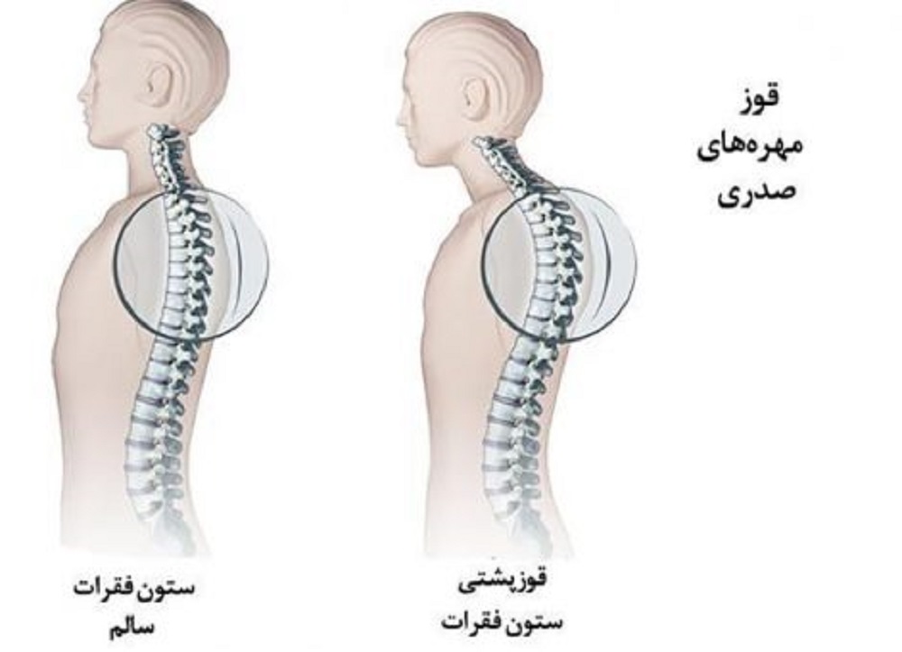 چگونه با ۷ ورزش قوز پشت را درمان کنید؟ - دانستنی های ورزشی چگونه با ۷ ورزش قوز پشت را درمان کنید؟