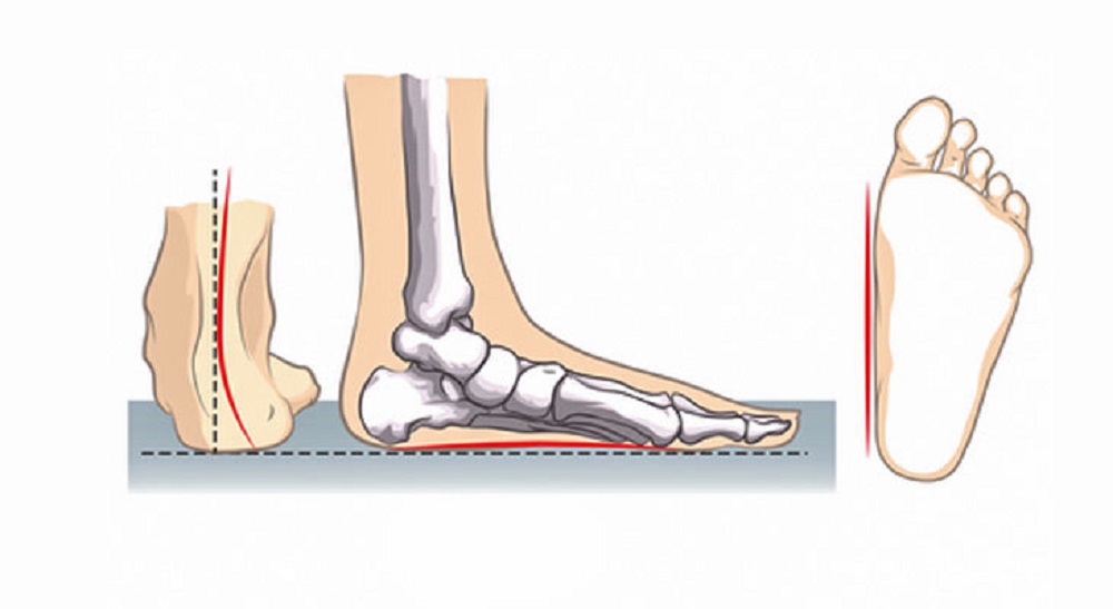 علت صافی کف پا چیست و چگونه کف پای صاف را درمان کنیم؟