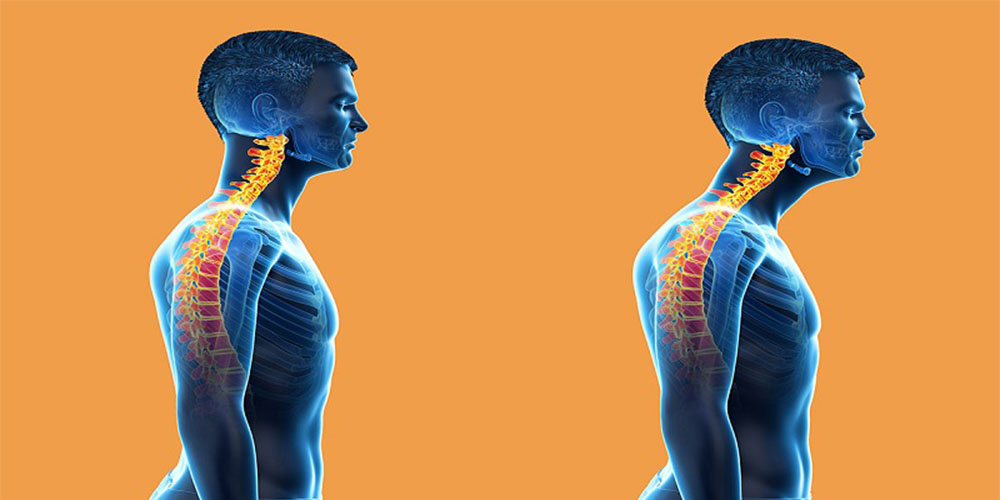 ناهنجاری سر به جلو و حرکات اصلاحی درمان سر به جلو - دانستنی های ورزشی ناهنجاری سر به جلو و حرکات اصلاحی درمان سر به جلو