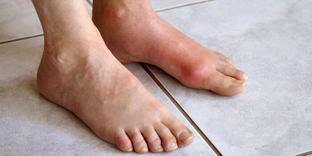 بهترین ورزش ها برای مبتلایان به نقرس - دانستنی های ورزشی بهترین ورزش ها برای مبتلایان به نقرس