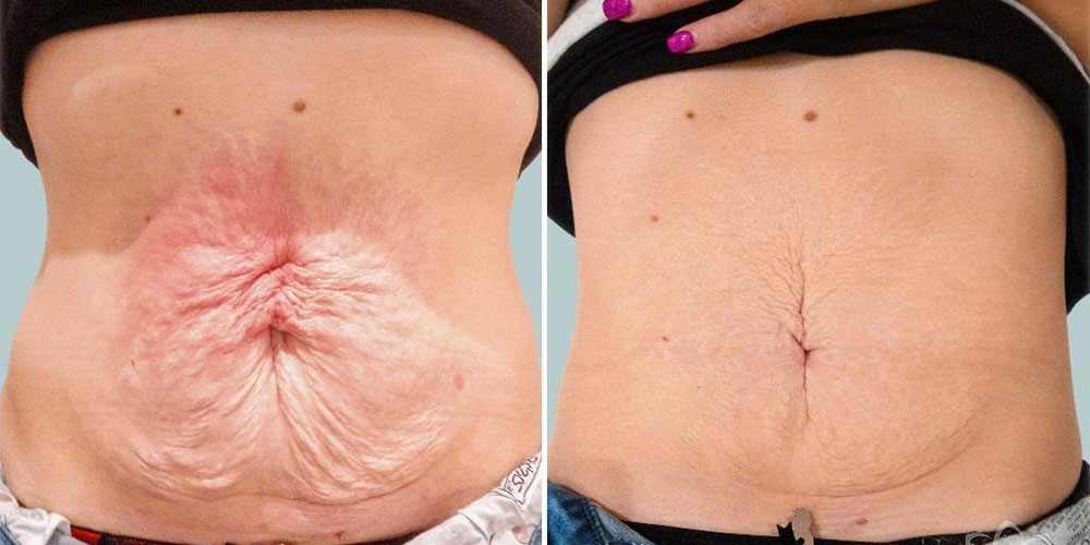 جلوگیری و درمان شلی و افتادگی پوست بدن بعد از لاغری - دانستنی های ورزشی جلوگیری و درمان شلی و افتادگی پوست بدن بعد از لاغری