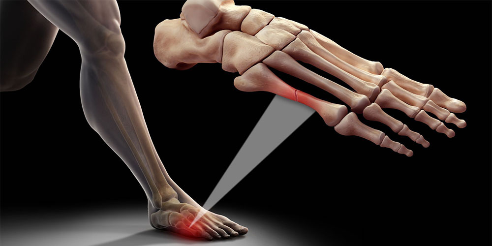 درمان شکستگی انگشتان پا - دانستنی های ورزشی درمان شکستگی انگشتان پا