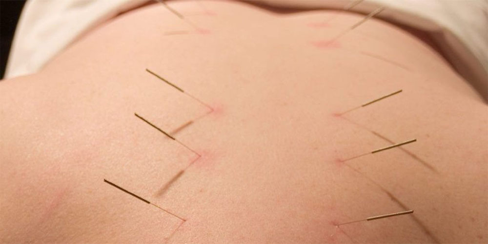 همه چیز در مورد سوزن خشک و فواید آن برای ورزشکاران - دانستنی های ورزشی همه چیز در مورد سوزن خشک و فواید آن برای ورزشکاران
