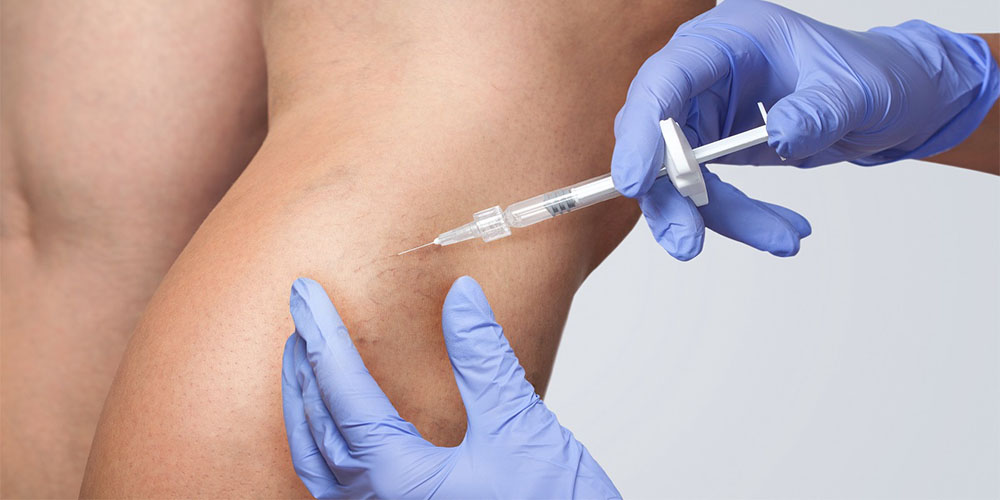 واریس را با یک تزریق ساده درمان کنید! - دانستنی های ورزشی واریس را با یک تزریق ساده درمان کنید!