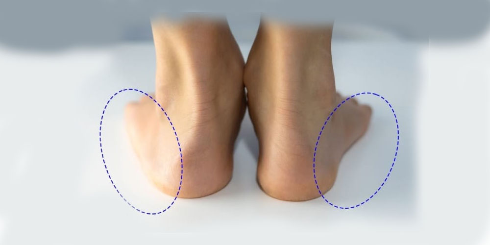 علایم و عوارض كف پای صاف - دانستنی های ورزشی علایم و عوارض كف پای صاف