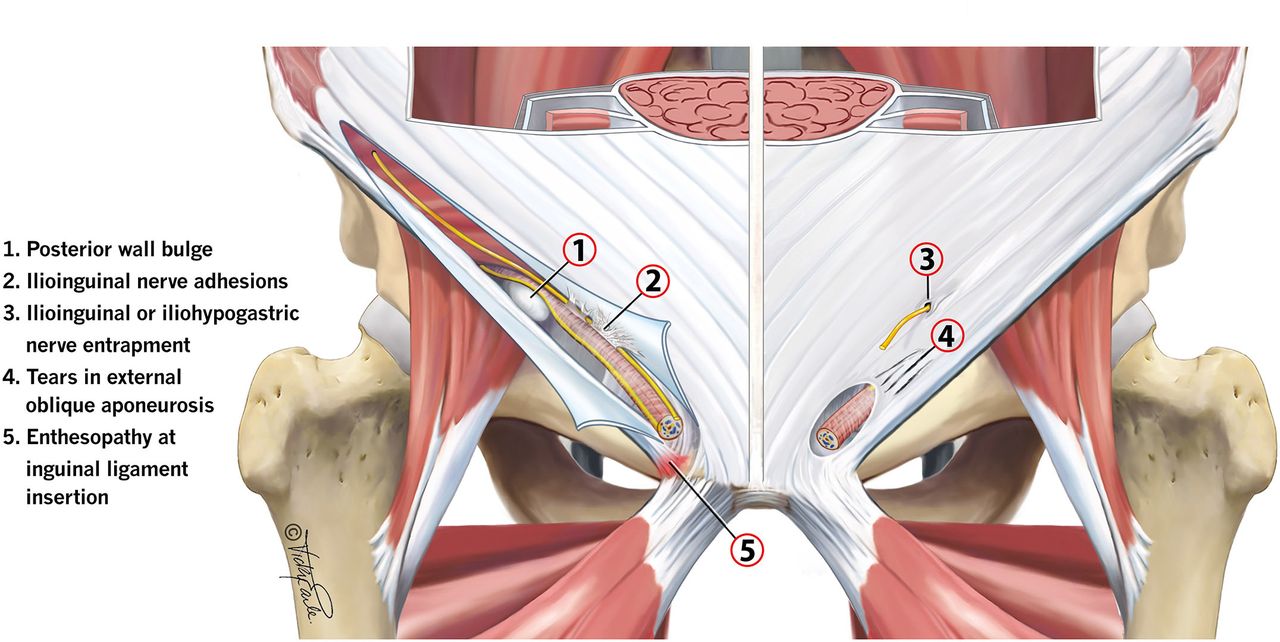 آیا پوبالژیا همان فتق ورزشی است