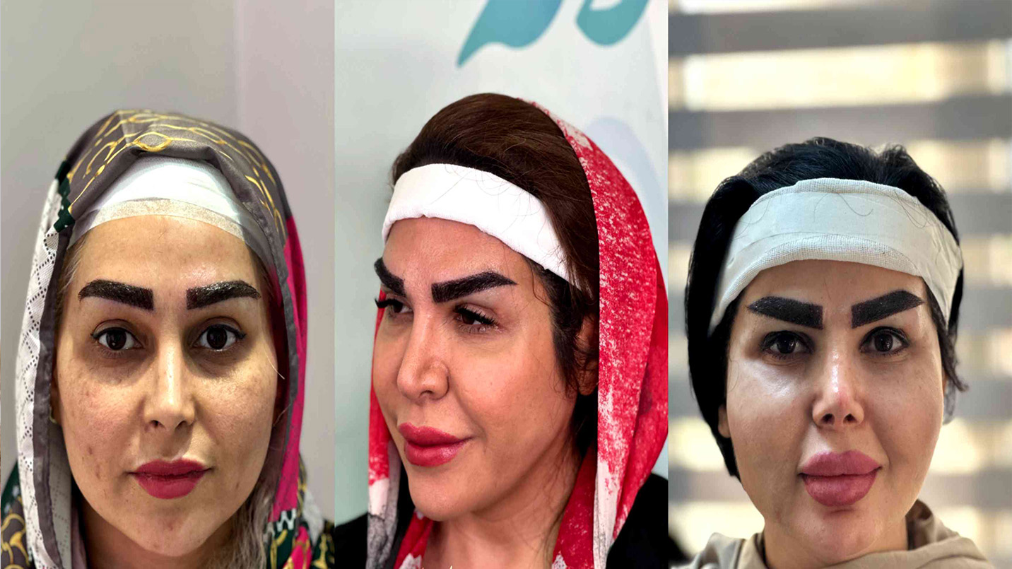 نمونه کار کاشت ابرو کلینیک لاله نمونه کار کاشت ابرو کلینیک لاله