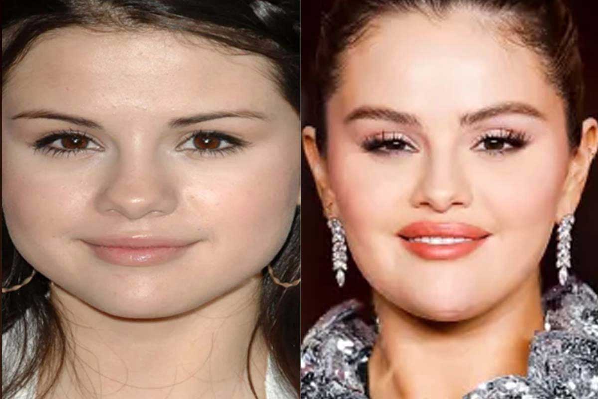سلنا گومز قبل و بعد از عمل بینی