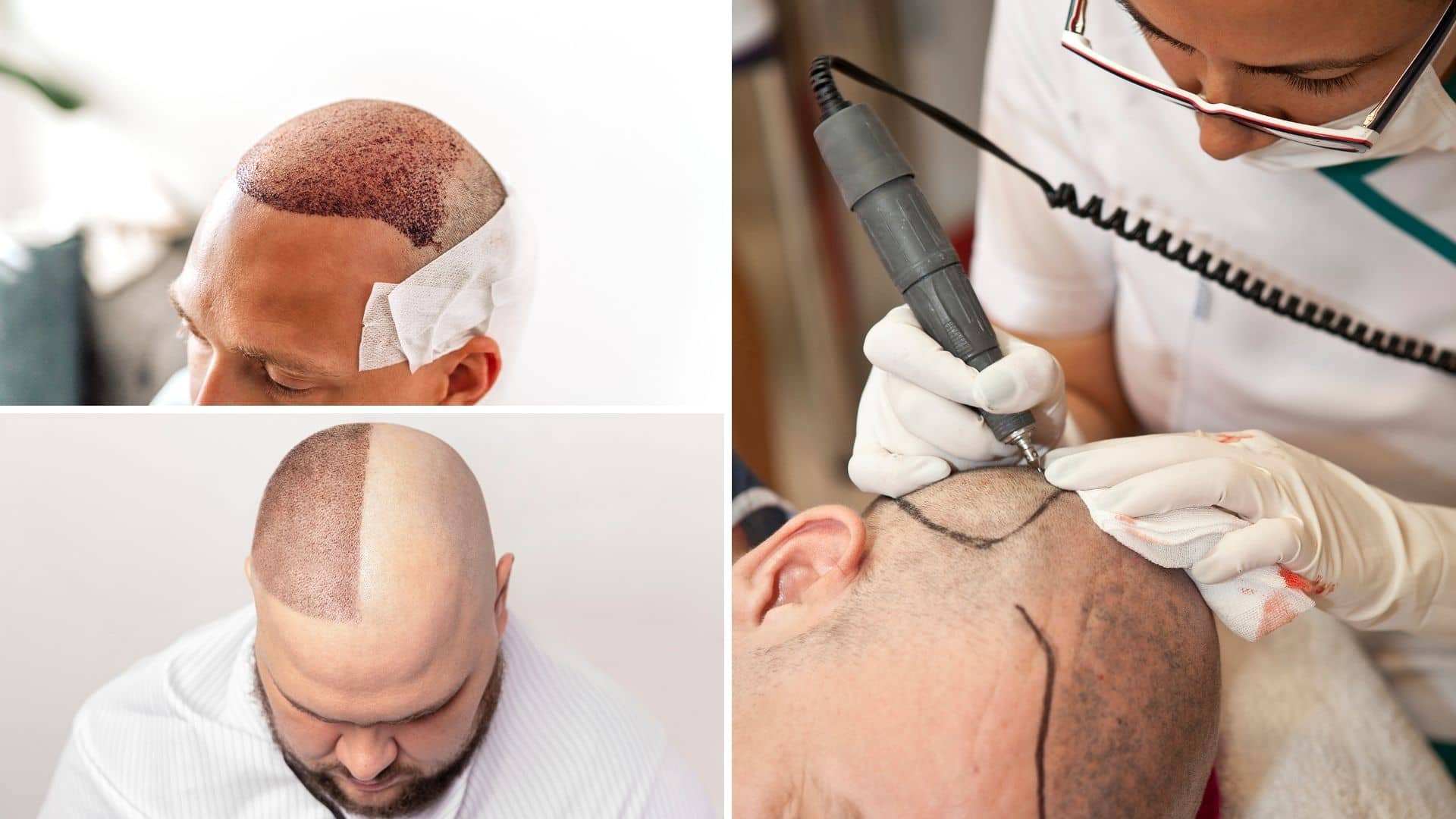 بهترین کلینیک کاشت مو در خاورمیانه